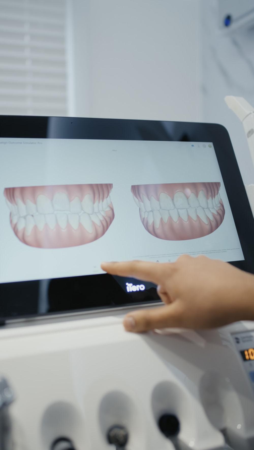 Dentist leigh essex composite bonding veneers invisalign